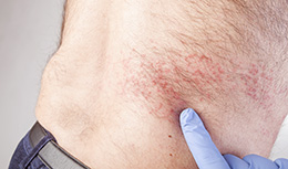 shingles symptoms