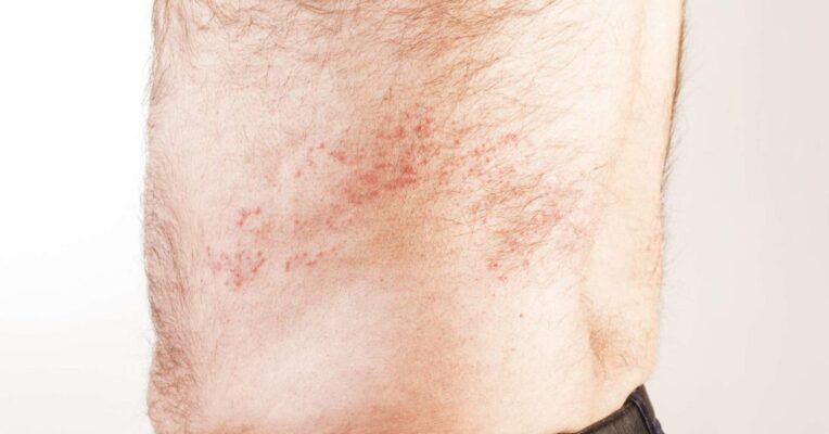 shingles symptoms